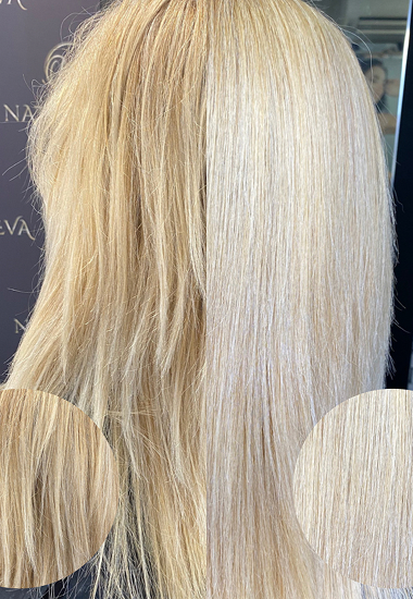 NANOPLASTIA TREATMENT